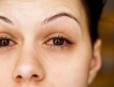 Που μπορεί να οφείλεται το κοκκίνισμα των ματιών